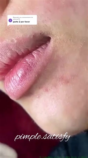 Satisfying Blackhead Removal Techniques