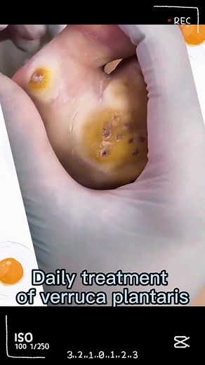 Effective Treatment for Verruca Plantaris on Feet