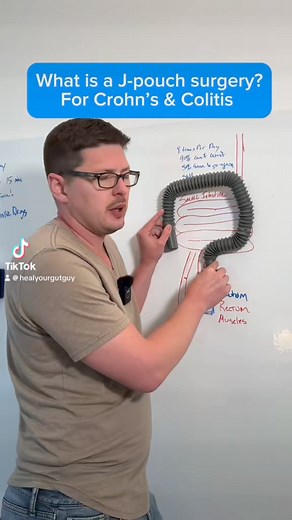 J-Pouch surgery for crohn’s & Colitis. Does is actually work?! Get my program here: https://www.healyourgutguy.com . . | Heal Your Gut Guy