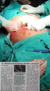 Full video article: i​Compared closed reduction or older fixation methods, open reduction and