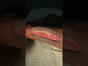 Ulcer examination : A complete overview