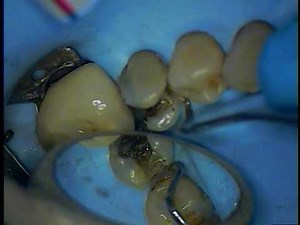 Crown preparation with buildup - mandibular left second permanent premolar 1/5
