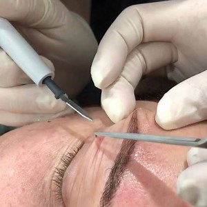 Don’t watch if you’re a little squeamish! ⠀ ⠀ Diathermy can be used to remove skin tags, moles and cherry angiomas. ⠀ ⠀ This procedure is pain free as we’re able to use a local anaesthetic to completely numb the area! 🙌🏼 | Injex Clinics