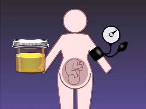 Reducing the Risk of Preeclampsia in Pregnant Women | NEJM