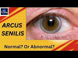 White ring ? what they say? Corneal arcus explained in detail ‪@eyecareoptom5506‬ #eye #arcus