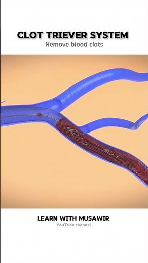 Procedure to remove blood clots 😳!