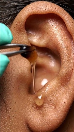 Ear Blackhead Extraction ASMR 👂😮‍💨 Rate It 1–10