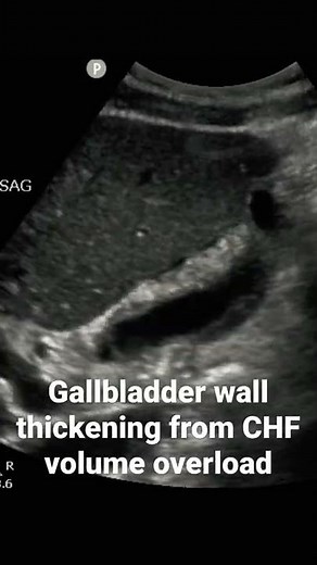 Gallbladder wall thickening from CHF volume overload