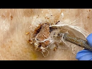 DR LEE’S ULTIMATE ZITPOPPERA achieve Inner Peace with Botfly Removal Ingrown feel roundforgets sound