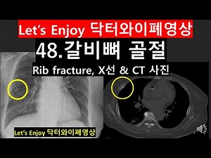 48 갈비뼈 골절 사진 Xray CT#rib fracture CT X-ray#늑골 골절 사진#닥터와이폐영상#Dr Y's chestradiology