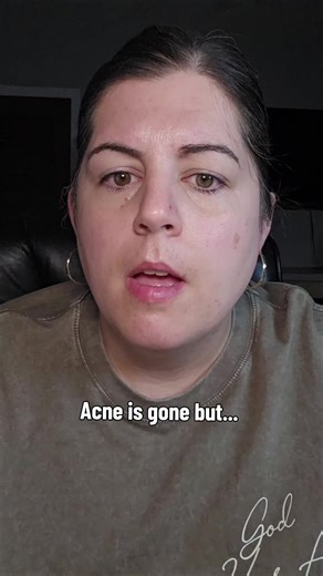 Acne gone but dark spots won’t fade? This is how you fix uneven skin tone and finally get clear skin. #acnescars #darkspots #hyperpigmentation #clearskin