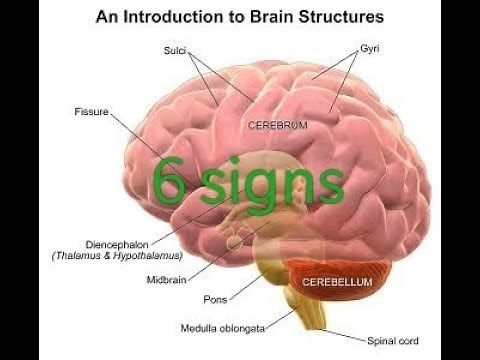 6 signs or symptoms of cerebral edema