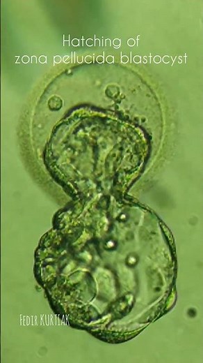 Hatching of a human blastocyst from the zona pellucida. #life #icsi #embryologist #blastocyst #ivf