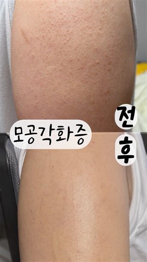Great tips for easily getting rid of keratosis pilaris at home