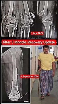 femur bone condyle fracture Recovery Update after 3 months of Mr. sanu