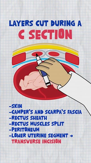 🚨 Emergency C-section = Every second matters 🕒 Goal: Decision to incision