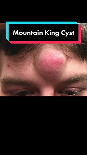 In the hall of the true mountain king... #drpimplepopper #SLMDskincare #learnontiktok