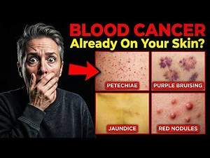14 Silent Symptoms of Blood Cancer That Show in Your Skin (Daily You Ignore It)