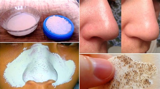 How to Remove Blackheads Naturally