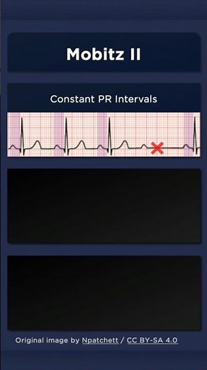 Type II Second Degree Atrioventricular Block ECG: Constant PR intervals