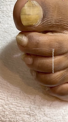 Lifted Toenail with Fungus — Reattached After Just 3 Pedicures This nail was lifted, damaged, and dealing with fungal changes — and instead of ignoring it or jumping straight to medication, we focused on proper nail care, protection, and consistency. Over 3 structured pedicure services, the nail environment improved, the new growth remained protected, and the nail reattached naturally as it grew forward. This is what happens when: ✔️ The nail is trimmed and maintained correctly ✔️ The environmen