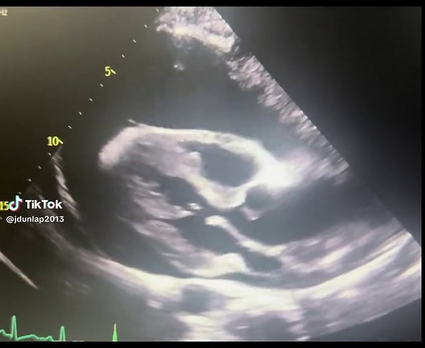 Emergency Intervention for Pericardial Effusion Case