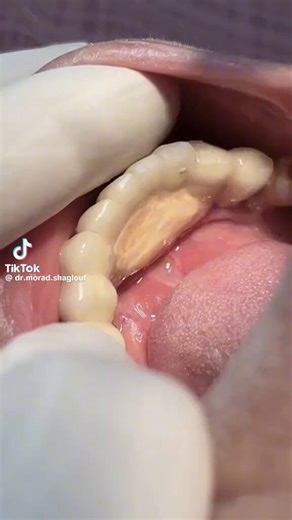 Scaling of tartar & calculus from teeth