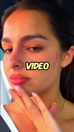 😳 Addison Rae CONFESSES Her SKIN Condition! 🚨💔