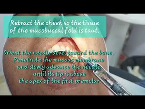 Local anesthesia Supraperiosteal infiltration technique anesthetizes maxillary left first premolar