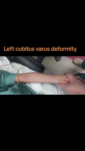 Corrective Osteotomy for Left Cubitus Varus Deformity