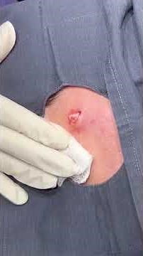 A cheeky cyst that was actually removed 2 years ago but came back.