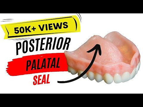 Posterior Palatal Seal (PPS)