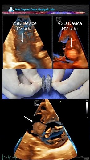 ✨ VSD Closure Magic: Tiny Device, Big Impact 🫀🔒