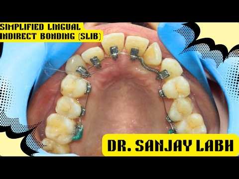 SLIB Clinical - SIMPLIFIED LINGUAL INDIRECT BONDING by Dr SANJAY LABH
