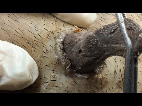 TLC DR LEE’S ULTIMATE ZITPOPPER / with Tweezer 580809M56527