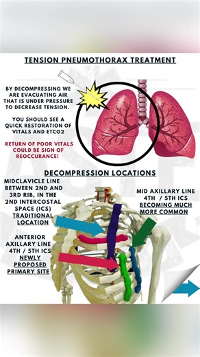 Needle Decompression #paramedic #paramediclife #paramedicschool #paramedicstudent #paramedicproblems #emt #ems #paramedico #paramedicsoftictok #paramedics #nursing #nursingschool #nurse