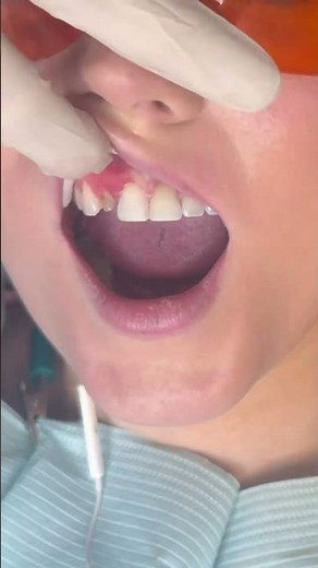 Front tooth crown | dental crown | cosmetic dentist | Dr. Yazdan | porcelain crown process