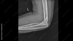 Radiographic image of the elbow, highlighting bones and joints.
