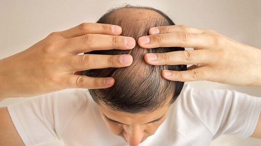 A popular hair loss drug and its lesser-known, rare and potentially life-altering side effects