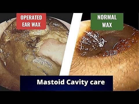 Mastoid cavity issues Purpose, Problems, Discharge, Deafness, Dizziness, Dependence
