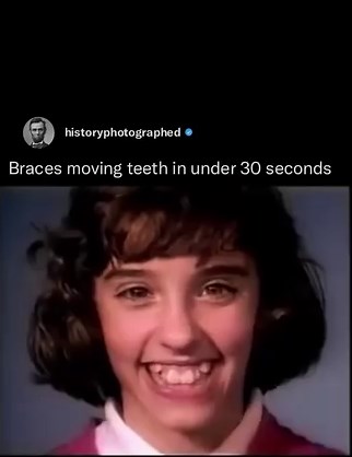 Timelapse of braces moving teeth in under 30 seconds: Braces work by exerting constant pressure on teeth and jaws to change their position and alter the smile. The brackets glued to teeth hold the archwire in place which places pressure on teeth. Over time teeth move into the desired position. The soft tissue that surrounds the teeth and bone are periodontal ligaments 😁 Video: ernestmccallum (YouTube) | History In Pictures