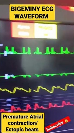 Bigeminy ECG pattern | Ectopic beats | PAC |#shorts