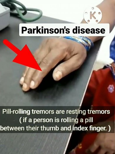 Pill-rolling Tremors- Parkinson's Disease
