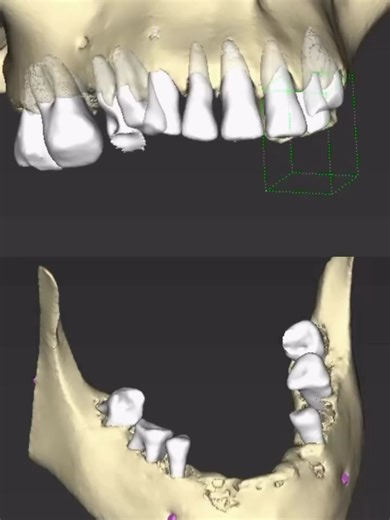 Stackable Guide An implant guidance solution that brings predictability to bone reduction and implant position.