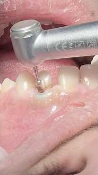 Composite veneer for anterior tooth and closing space between teeth #dentist