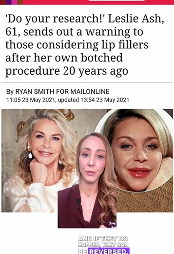 Leslie ash had silicone injected into her lips . Very dangerous and now very outdated . The filler we use today is made from hyaluronic acid and they can be reversed . #lipfiller #lipcontouring #fillerdissolving #fillerclinic