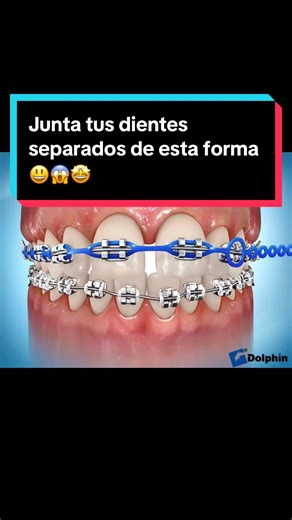 ✨ ¿Sabías para qué sirve la cadena elastomérica en los brackets? ✨ La cadena elastomérica es un pequeño pero poderoso aliado en tu tratamiento de ortodoncia 💪🦷 Su función principal es cerrar espacios entre los dientes, ayudando a que se muevan de forma controlada, segura y eficiente hasta lograr una sonrisa alineada 😁 📌 No es solo una “liguita”: ✔️ Aplica fuerza continua ✔️ Ayuda a cerrar diastemas ✔️ Mejora la estética y la mordida ✔️ Es clave en muchas etapas del tratamiento Si tienes brac