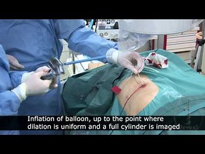 Percutaneous Nephrolithotomy And Balloon Dilation Of Ureteropelvic Junction Obstruction  • Video • MEDtube.net