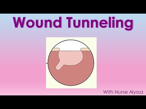Wound Tunneling What you should know