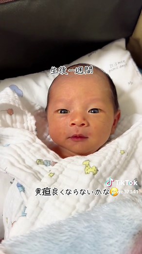 新生児のいる生活: 黄疸とその症状について知ろう